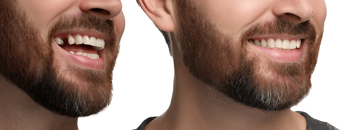 Tooth Implants Edmonton