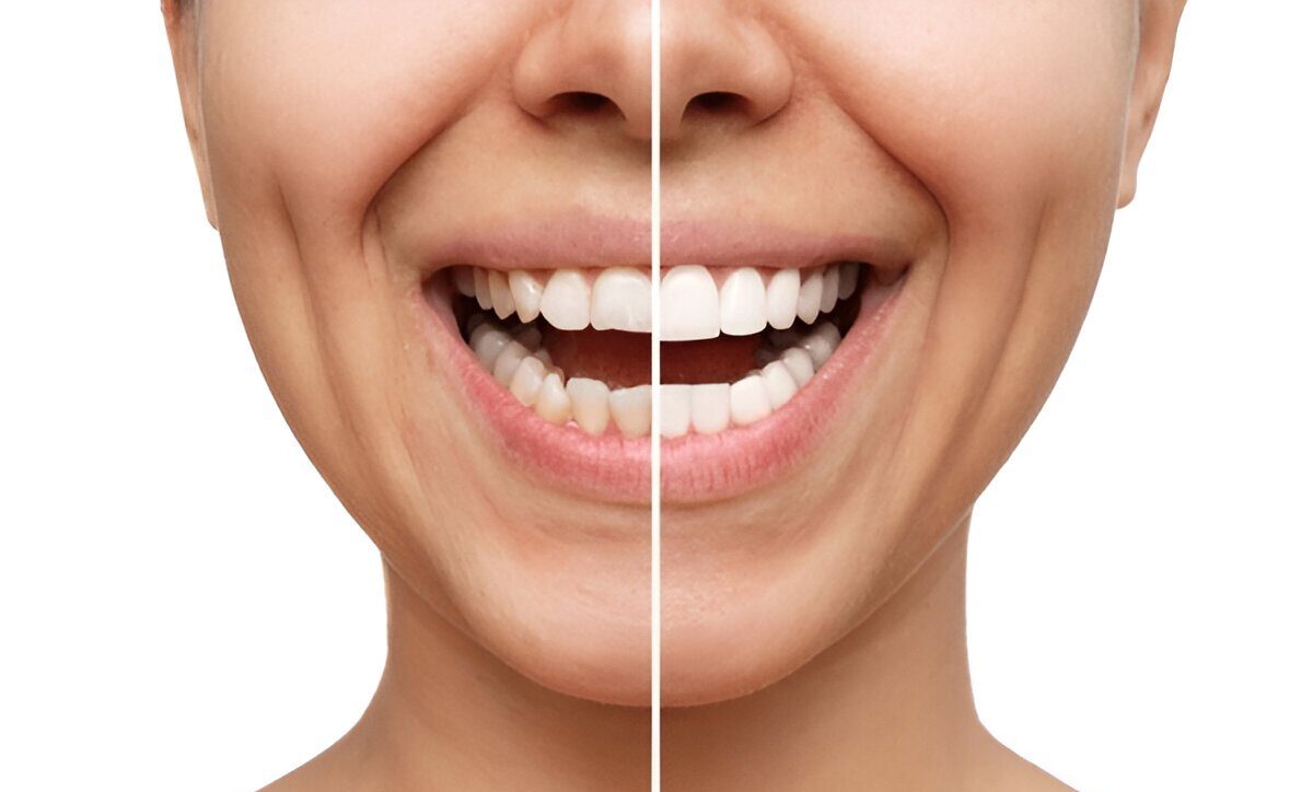 Cosmetic Dentistry Glenora